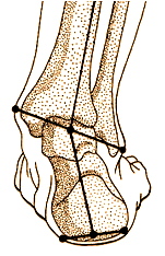 Ueberpronation