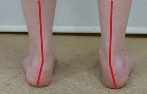 Ueberpronation